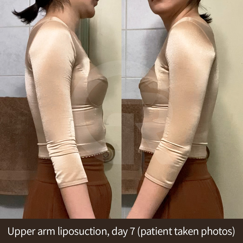 Treatment areas may include the upper arm, underarm, and bra line for balanced contours.