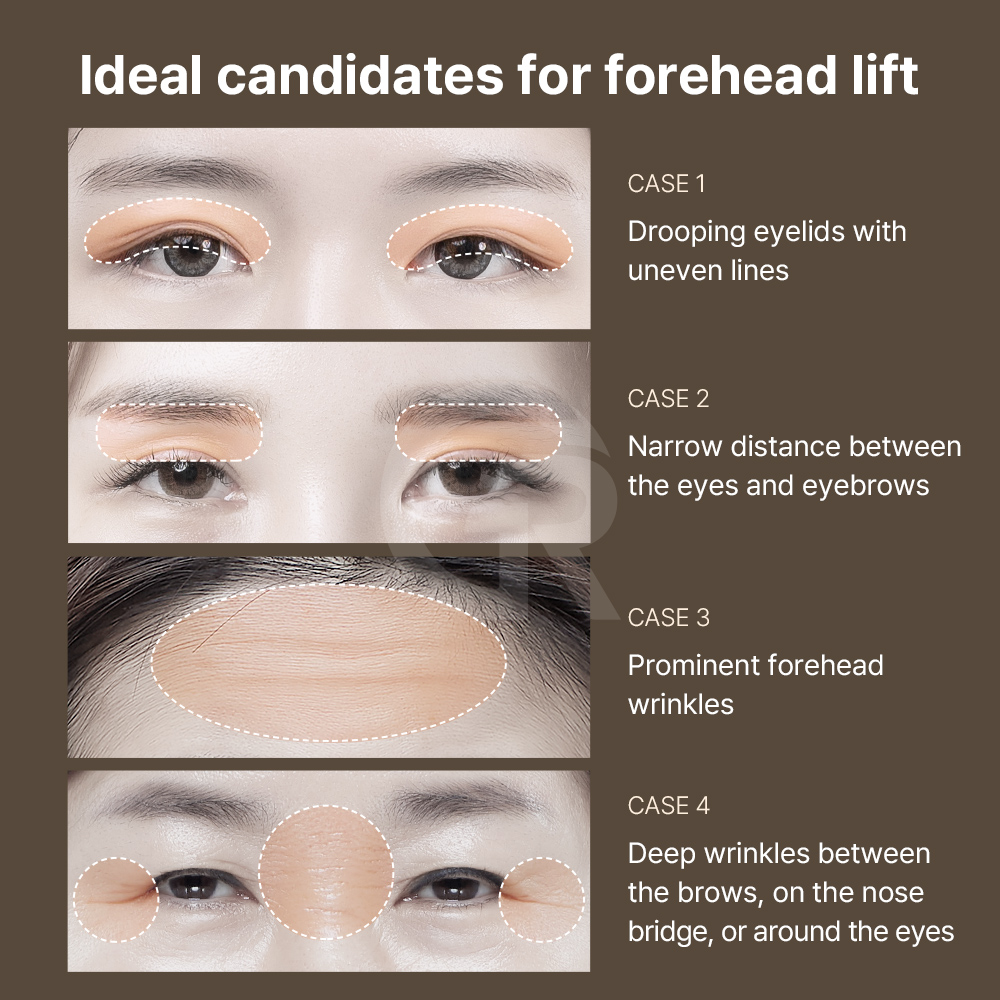 Upper blepharoplasty removes excess skin while maintaining a natural eye shape.