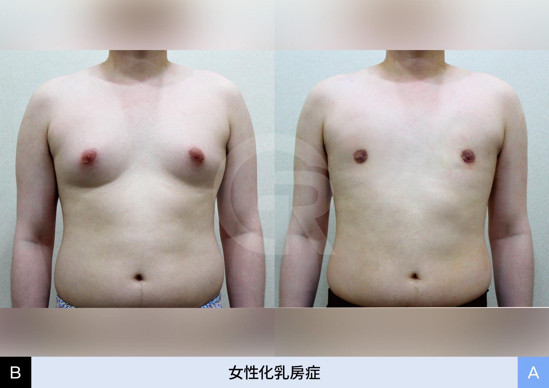 手術後に着用する専用圧迫バンドの装着例