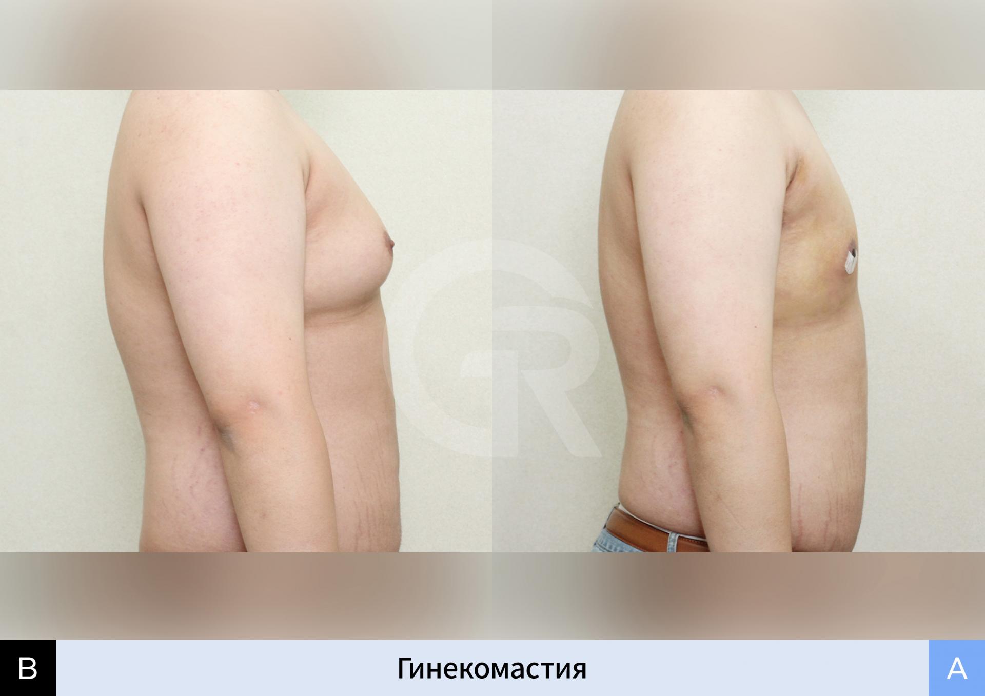 Ассиметричная грудь у мужчины, скорректированная хирургически