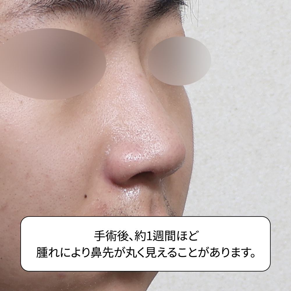 韓国鼻整形手術前の鼻構造分析。