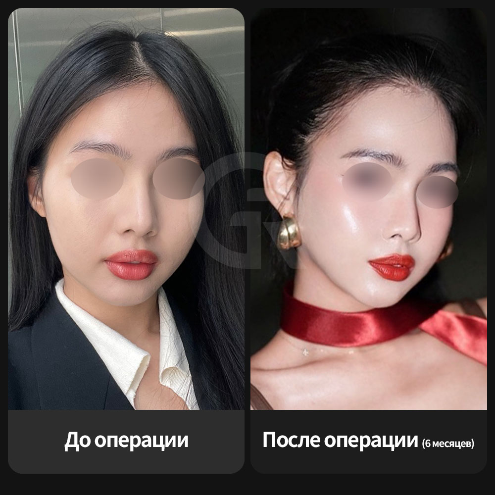 Внутриротовой подход снижает беспокойство по поводу внешних рубцов вокруг линии роста волос или зоны бакенбардов.