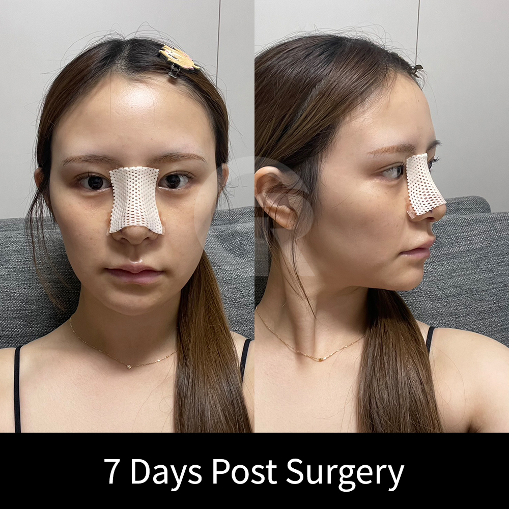 Bulbous nose correction should not make the nasal tip overly sharp; preserving a natural soft contour is important.