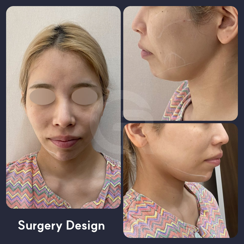 A protruding-mouth-like appearance should be analyzed through the teeth, jawbone, chin position, and airway condition before choosing a surgical plan in Korea.
