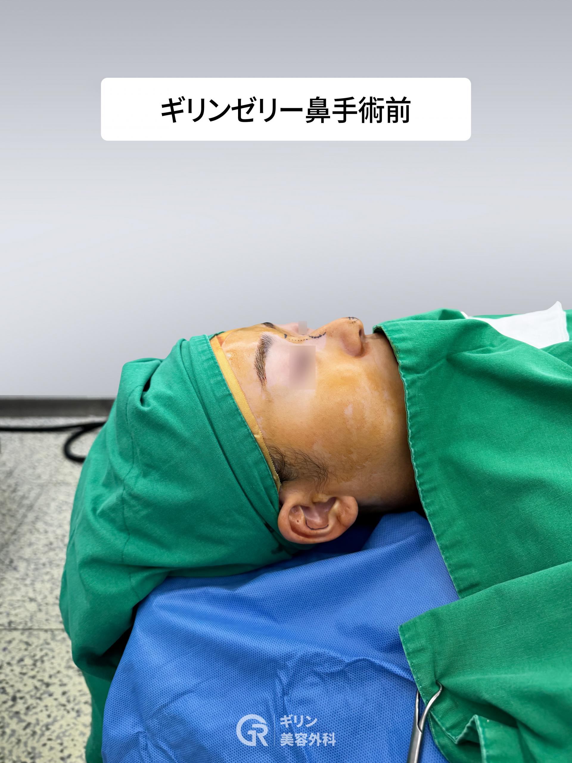 鼻孔内から行うクローズド手術 ― 傷跡を残さないジェリコ法。