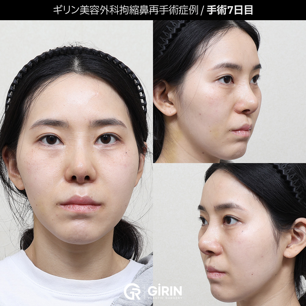 ギリン整形外科｜拘縮鼻（こうしゅくび）再建症例 : 韓国ギリン美容