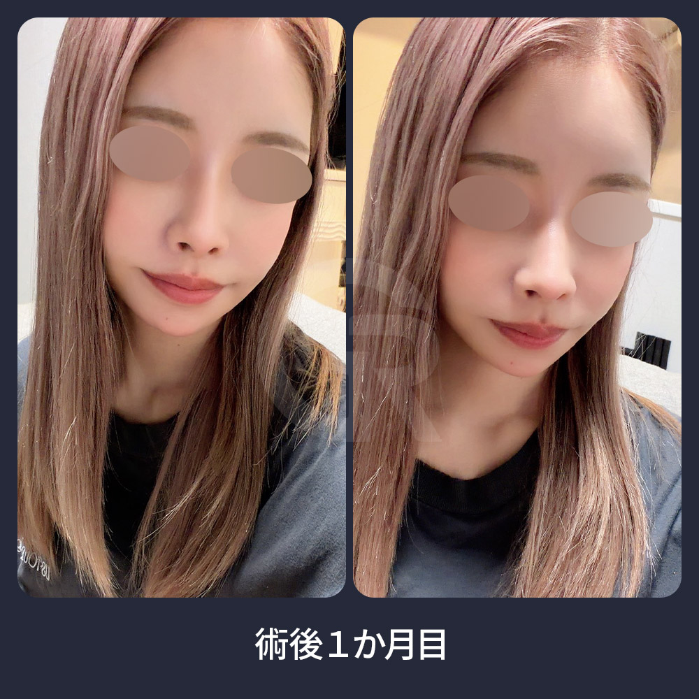ギリン美容外科の輪郭手術は、骨を過度に削ることではなく、患者様ご自身の骨格に合った自然な比率を重視します。