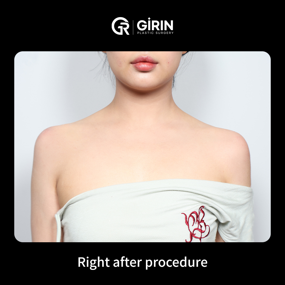 Non-surgical shoulder contouring with natural-looking results