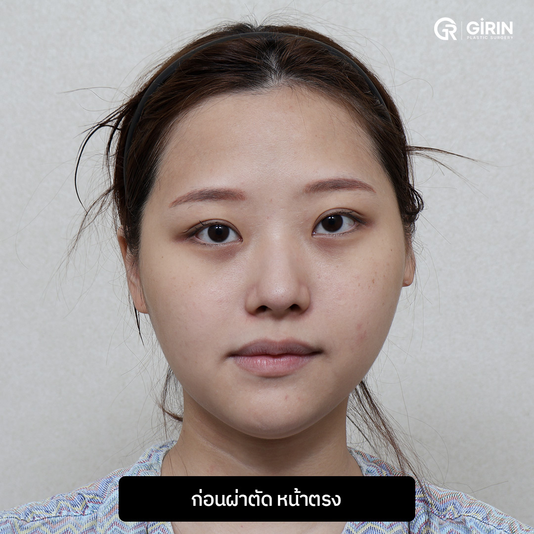 แก้ไขความไม่สมมาตรของใบหน้าอย่างแม่นยำด้วยเทคนิค Orthognathic Surgery