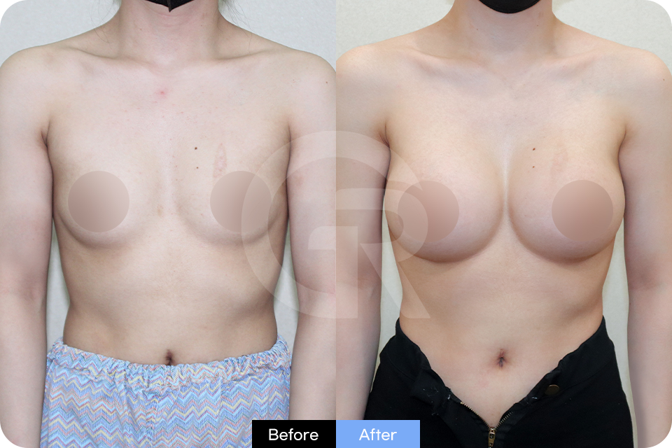 Girin Plastic Surgery Korea Breast Augmentation case 03 Front