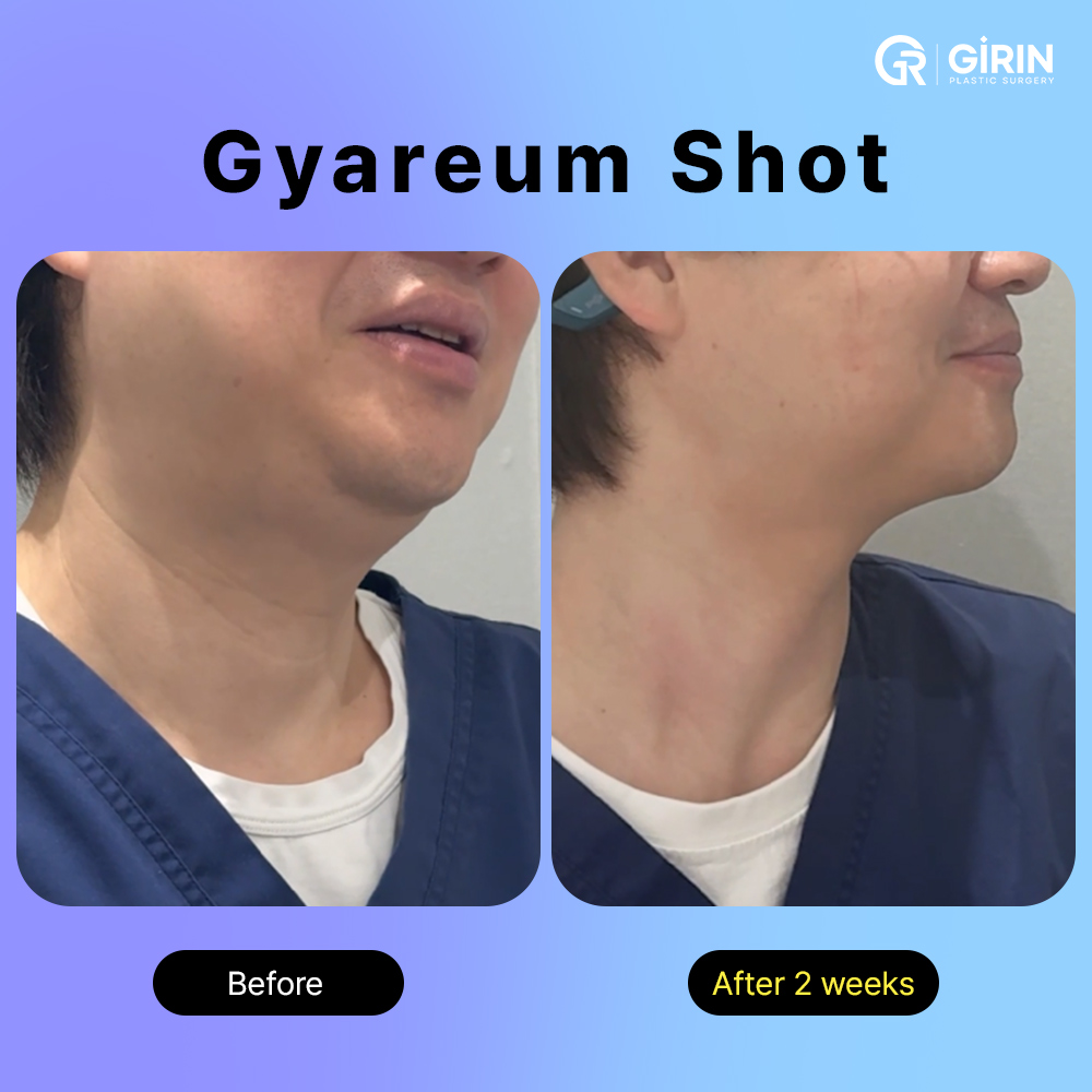 glutathione injection korea before and after Fat Dissolving Injection in Korea (Girin “Gareum” Injection) – Real  Experience from the Chief Surgeon : blog