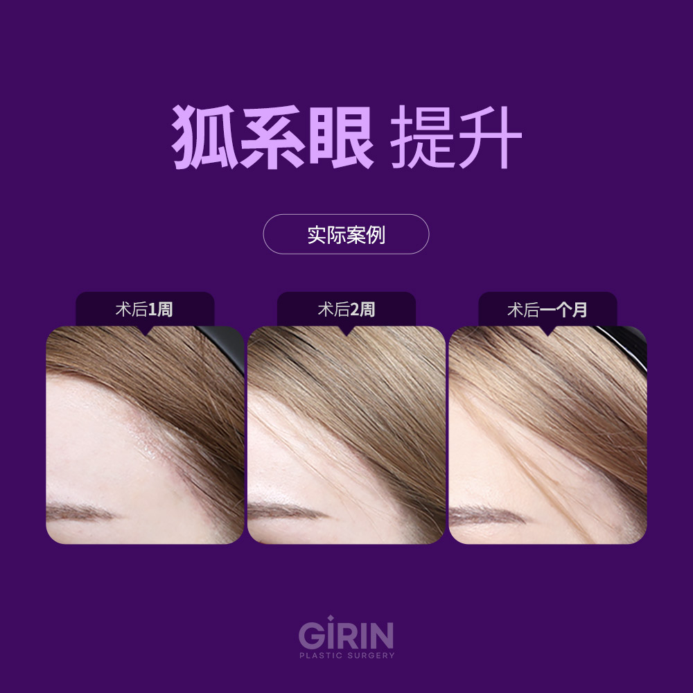 发际线内小切口,疤痕隐藏不明显。