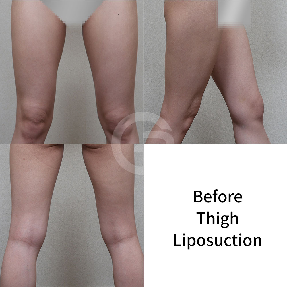 Saddlebags should be refined carefully because they connect the pelvis, hips, and outer thighs.