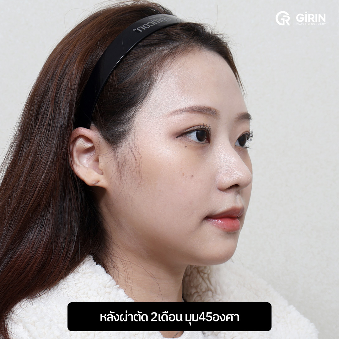 รูปหน้าส่วนล่างดูเป็นธรรมชาติและกลมกลืนมากขึ้น