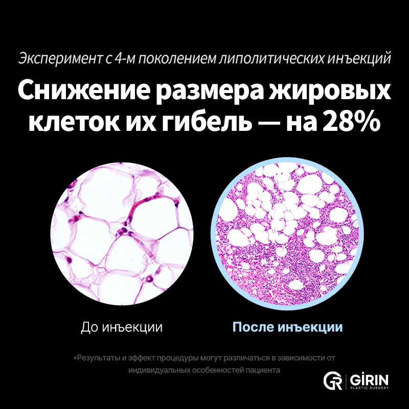 Контурные инъекции и Ultherapy для чёткого овала лица