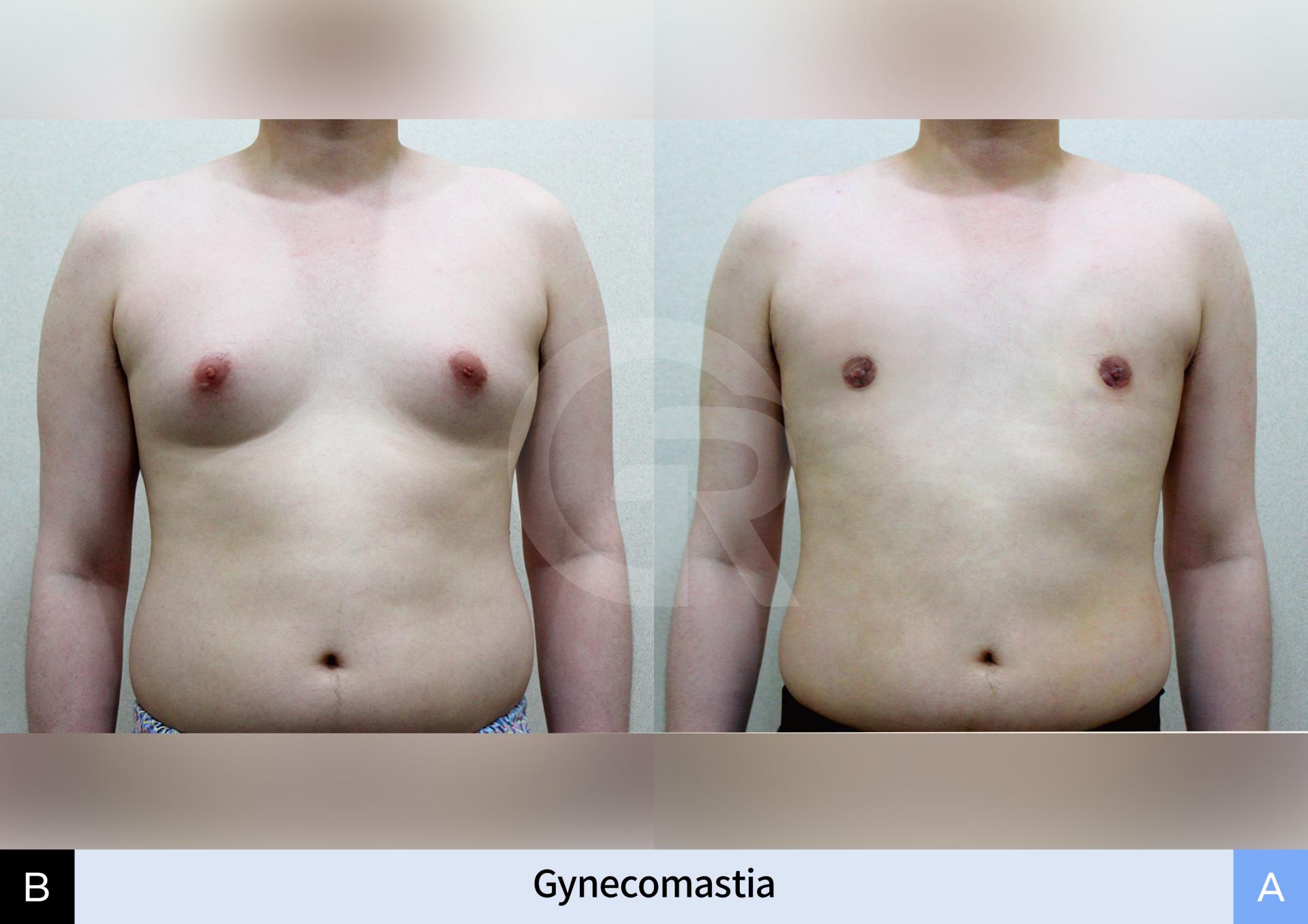 korean-gynecomastia-specialist.jpg.jpg