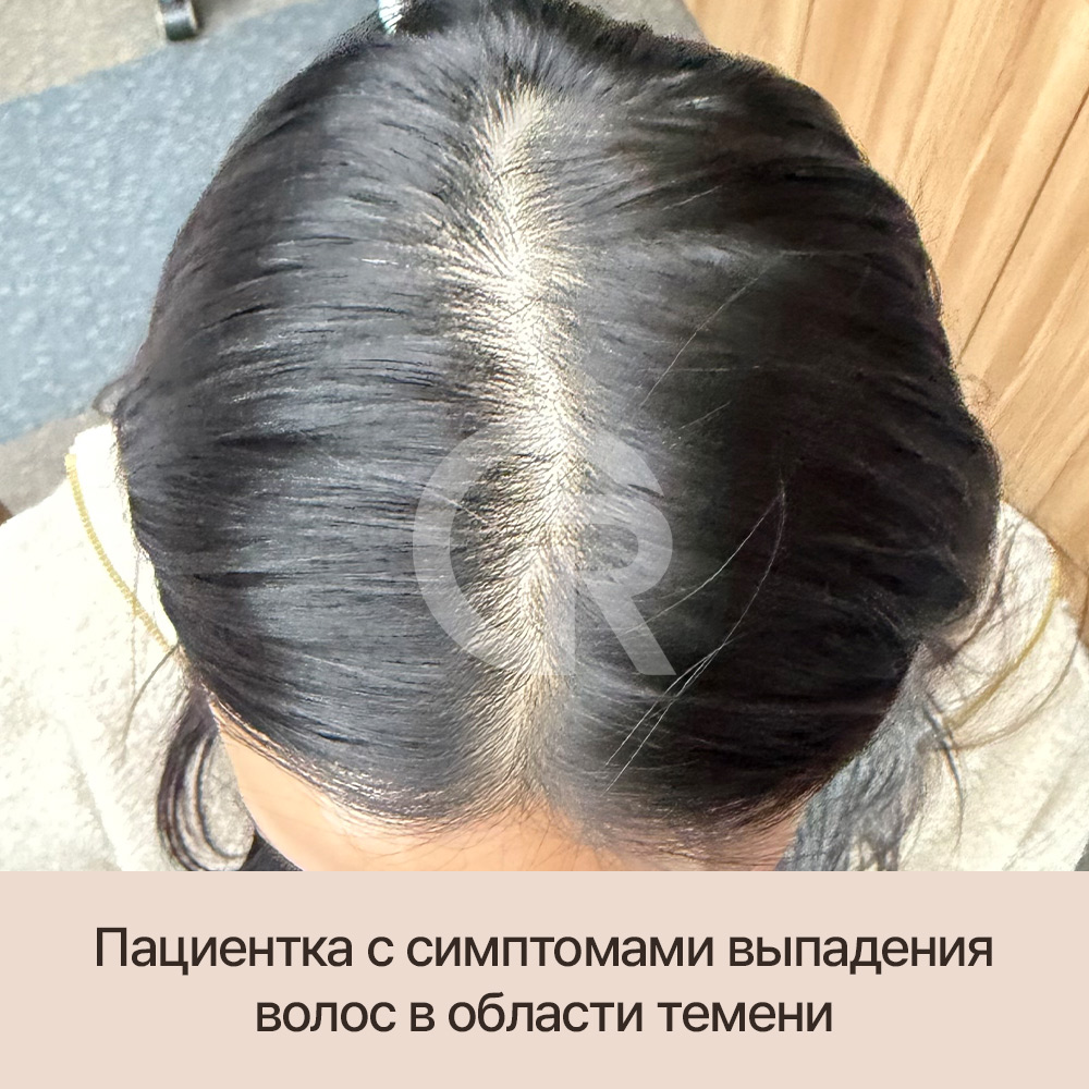 Это не просто выпадение волос — возможно, проблема уже в состоянии кожи головы