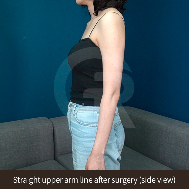 Temporary swelling and bruising are common during early recovery after surgery.
