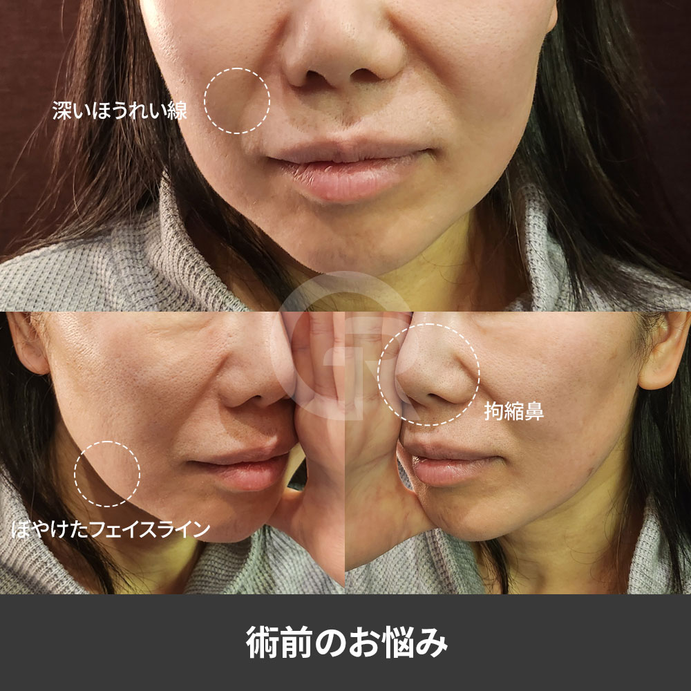 深いほうれい線の改善では、線を消すことより自然な立体感の回復が大切です
