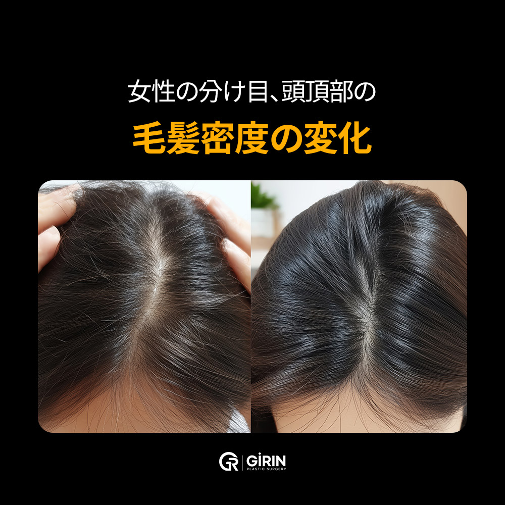 男性型・女性型、ストレス性、産後脱毛などさまざまな薄毛パターン。