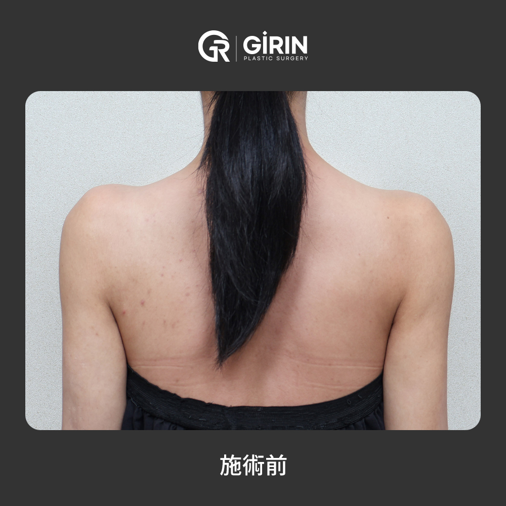 自然な肩ラインを作るヒアルロン酸注入