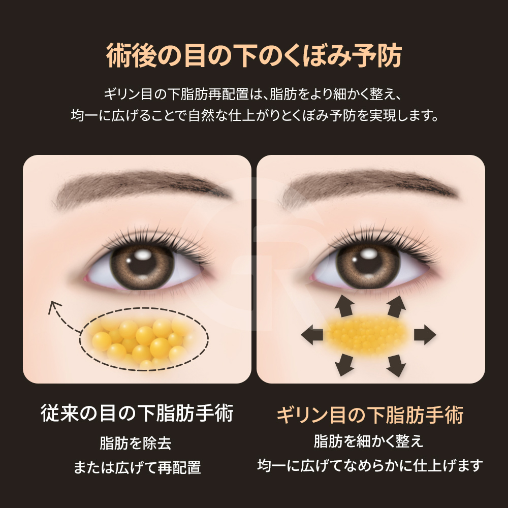 手術後は比較的短期間で日常生活への復帰が可能です。