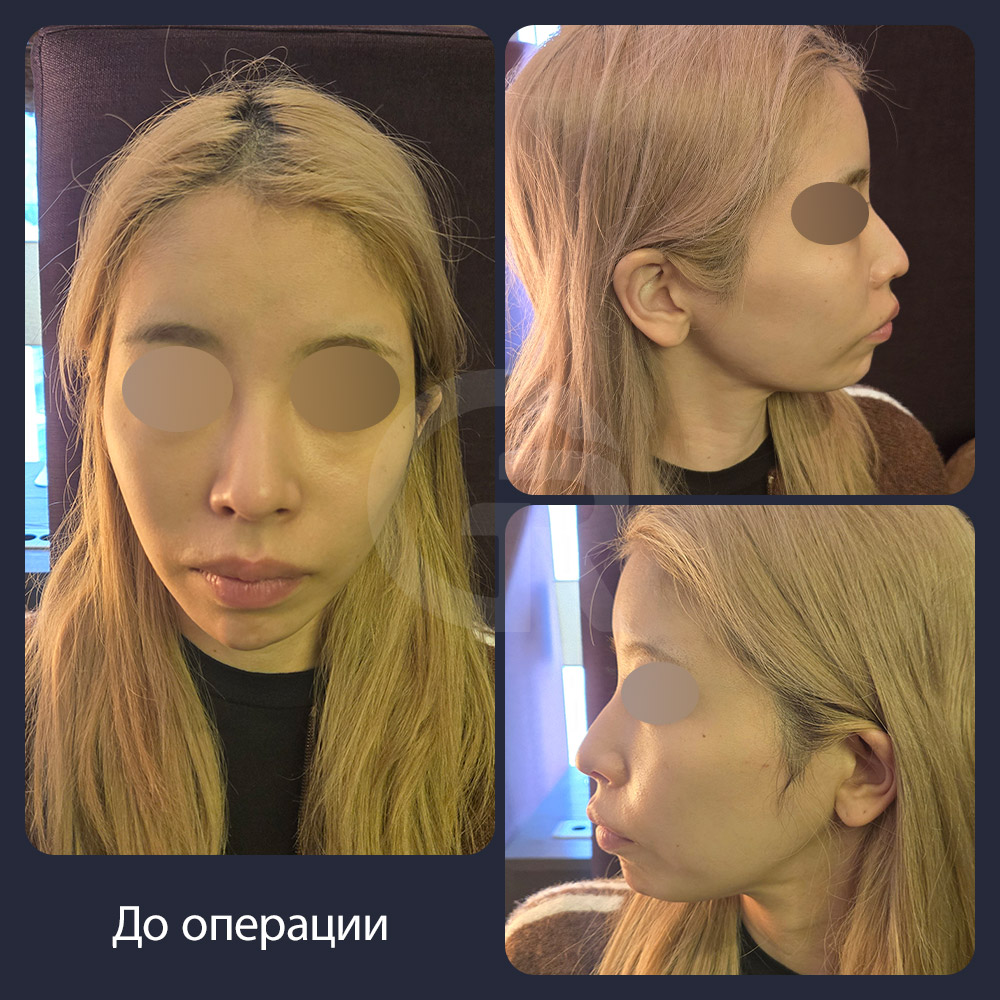 В Girin Plastic Surgery в Сеуле, Корея, контурная пластика лица и липофилинг могут рассматриваться как альтернатива, если операция на двух челюстях не подходит по соображениям безопасности.