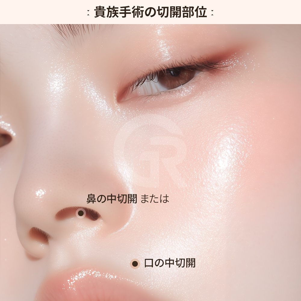 施術前の鼻翼基部の陥没状態