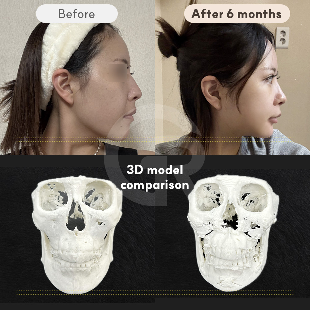 Recovery process after orthognathic surgery, highlighting the gradual stabilization of facial contour and soft tissue adaptation over time.