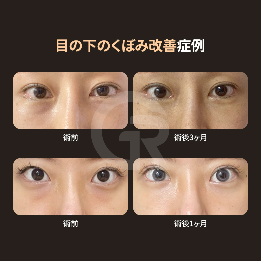 下眼瞼形成は皮膚のたるみを含めた総合的な矯正です。