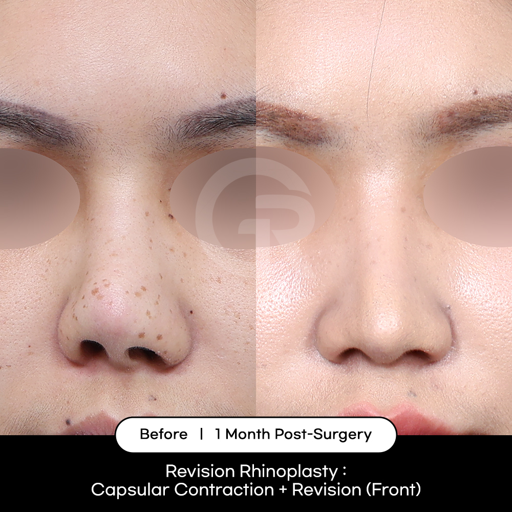 Natural revision rhinoplasty using customized analysis to restore balance and achieve refined, natural results