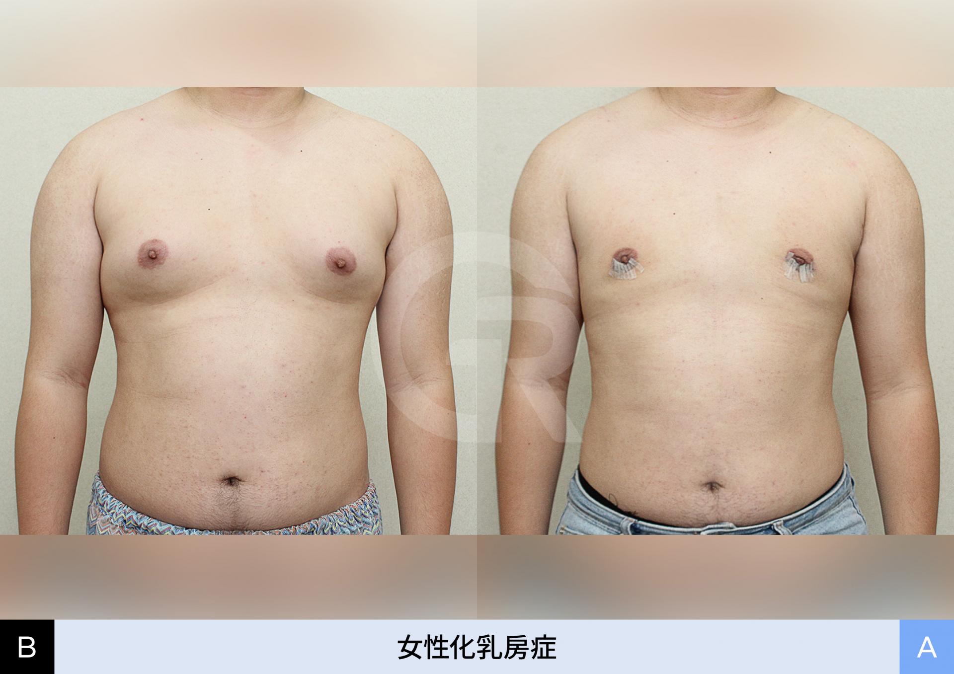 韓国・キリン整形外科で行った女性化乳房手術のビフォーアフター
