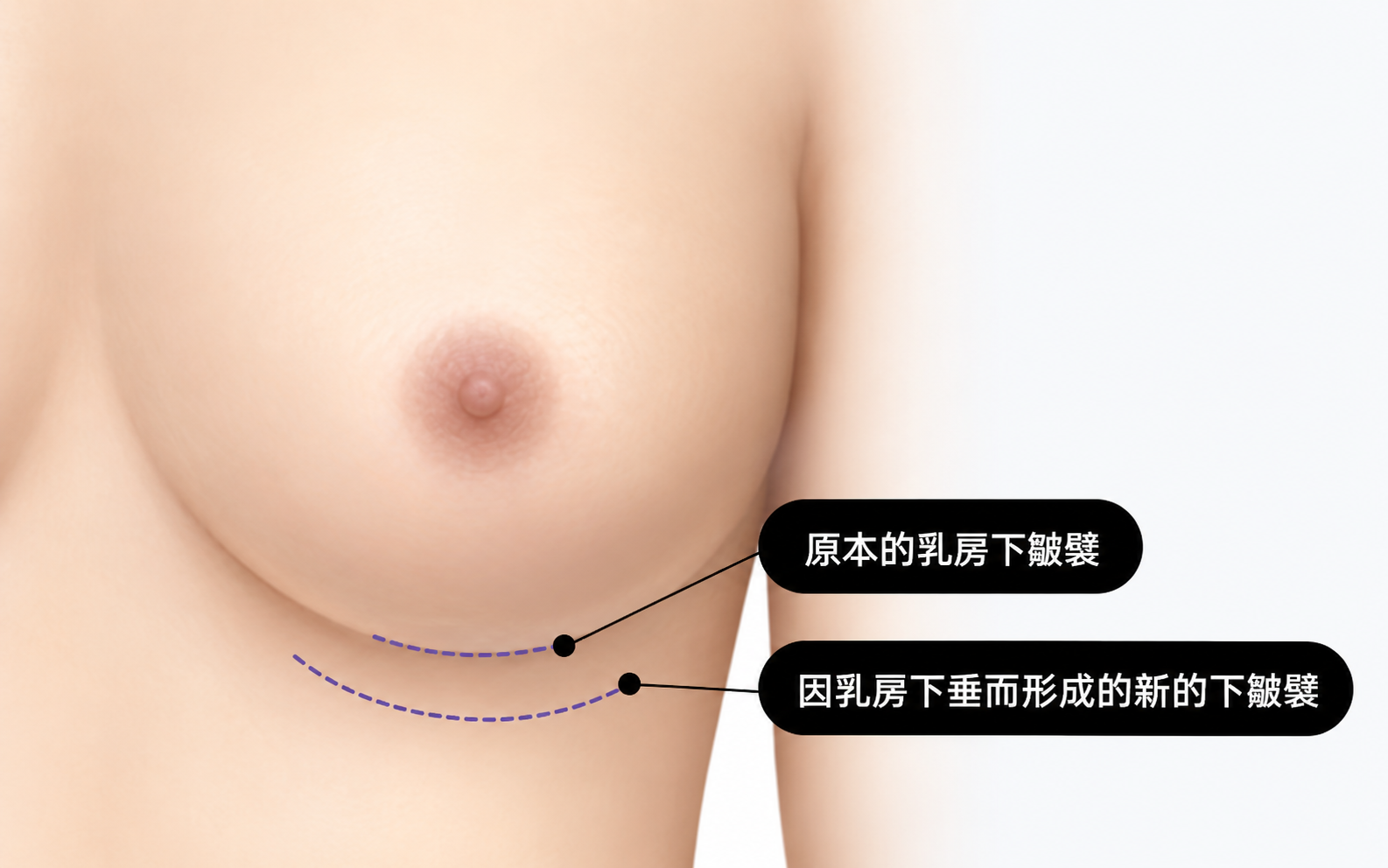 隆胸修复类型示意