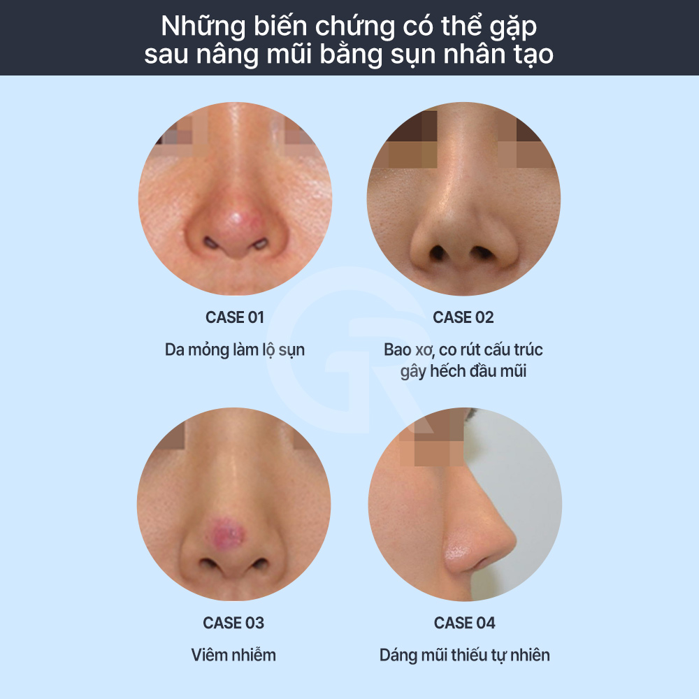Nâng mũi không dùng sụn nhân tạo tập trung vào dáng mũi tự nhiên và hài hòa với khuôn mặt.