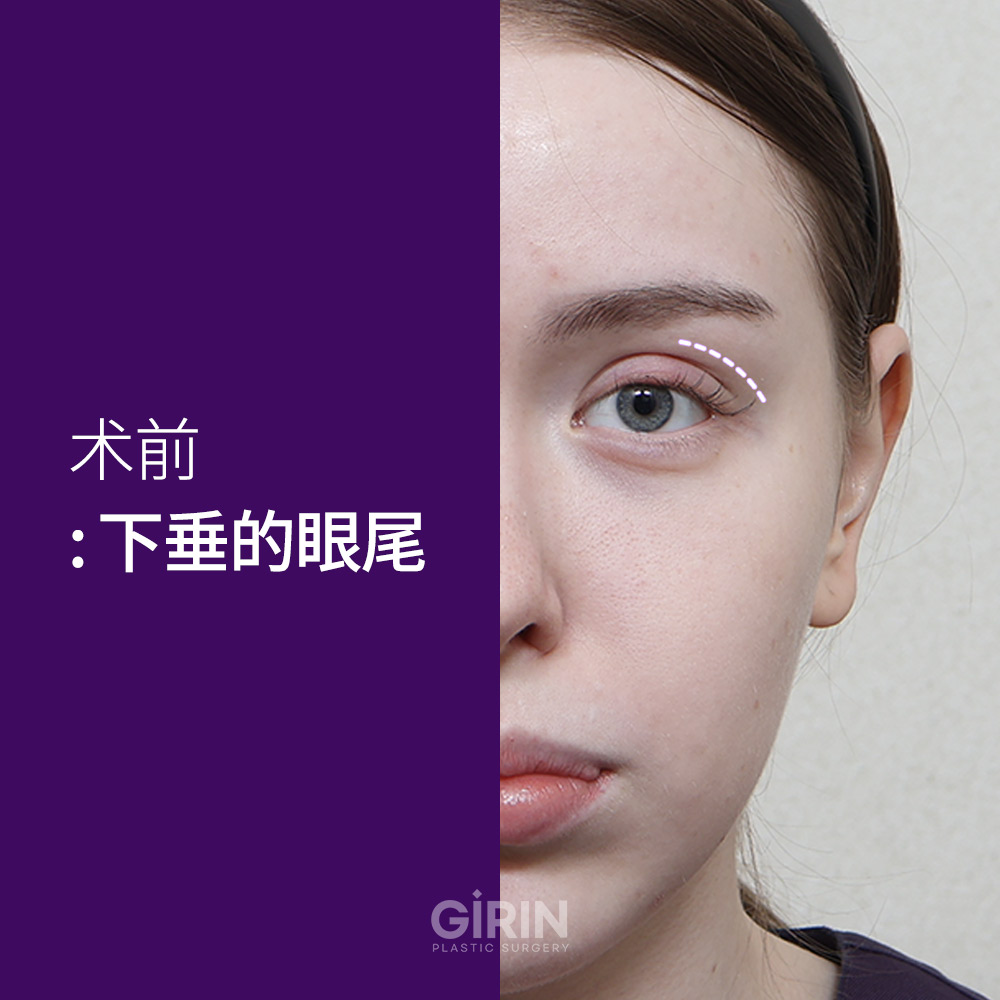 绮林整形外科根据个人脸型定制眼角角度。