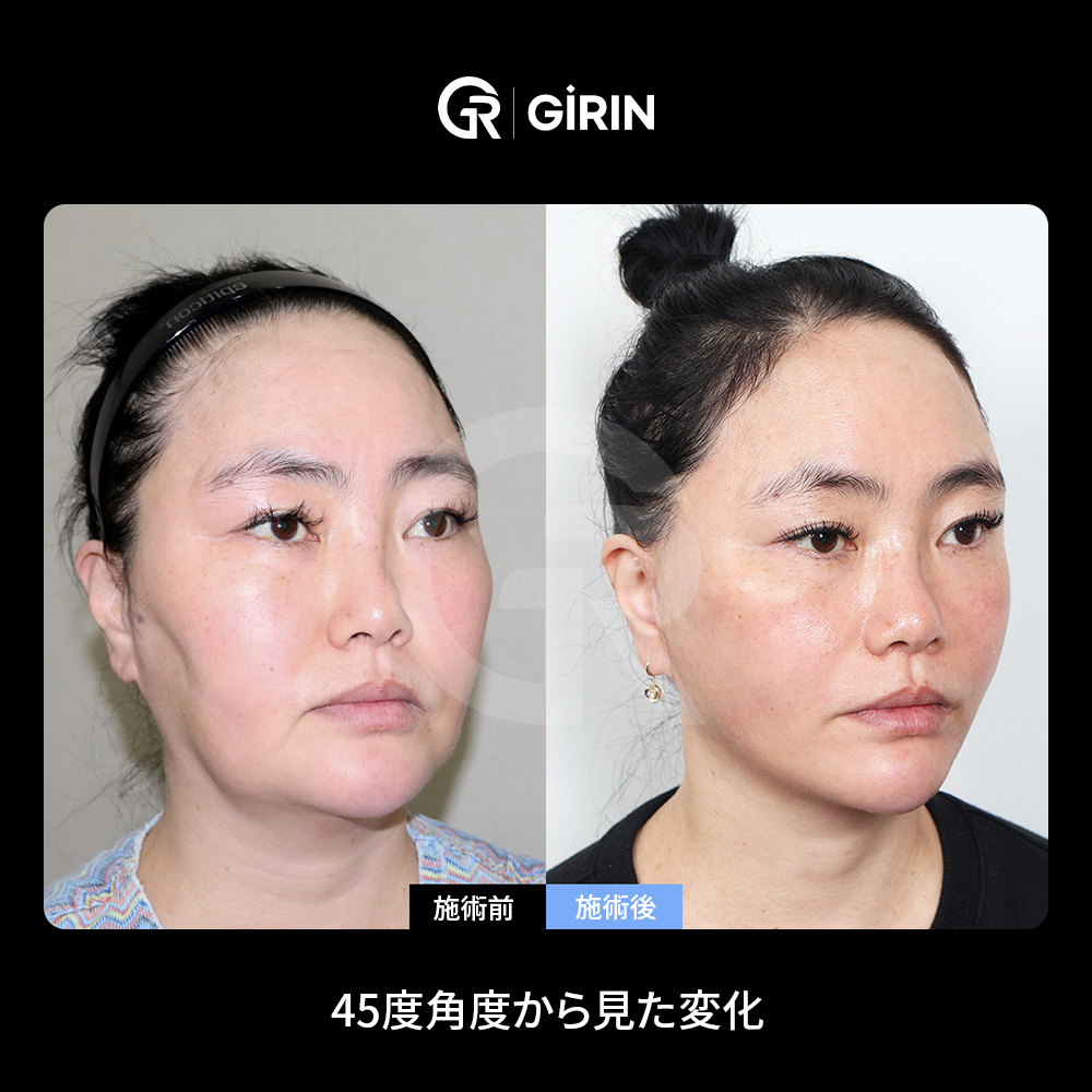 韓国でフェイスリフト手術の費用が異なる理由｜ミニフェイスリフトと