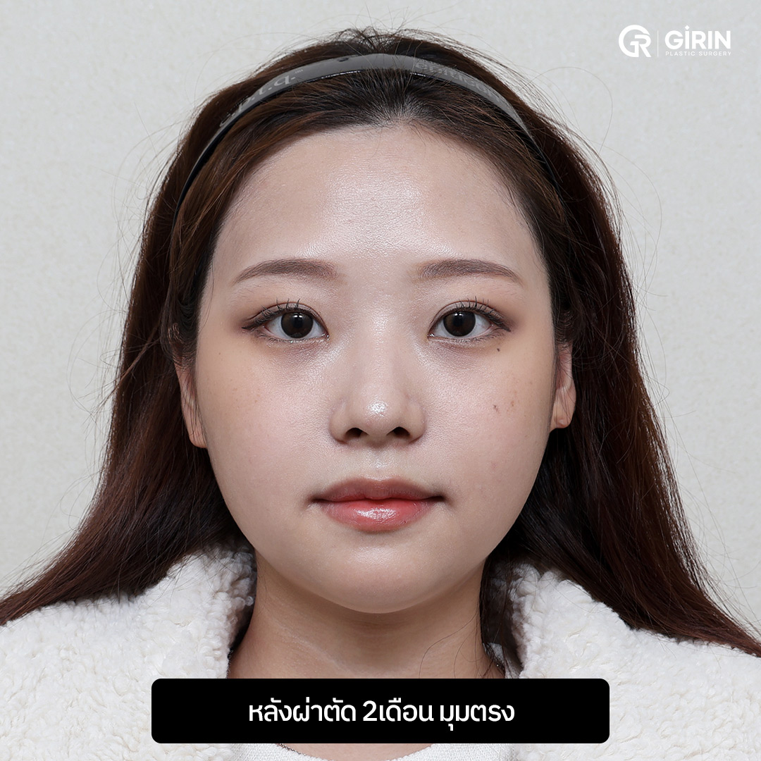 ปรับสมดุลของใบหน้าและการสบฟันให้มั่นคงยิ่งขึ้น