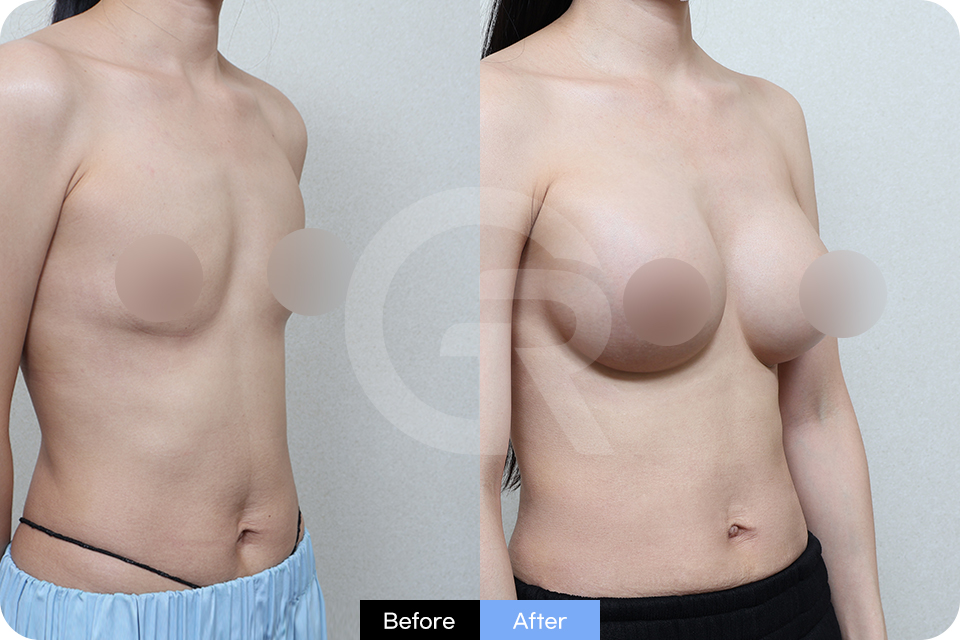 Girin Plastic Surgery Korea Breast Augmentation case 04 Half Side
