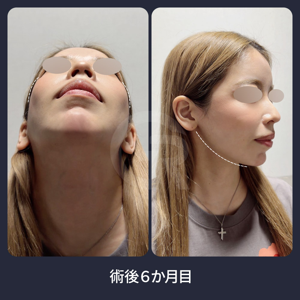 顎下の筋肉縛りは、筋肉の開きによって下顔面がぼやけて見える場合に、フェイスラインと首のラインのつながりを整える目的で行われます。