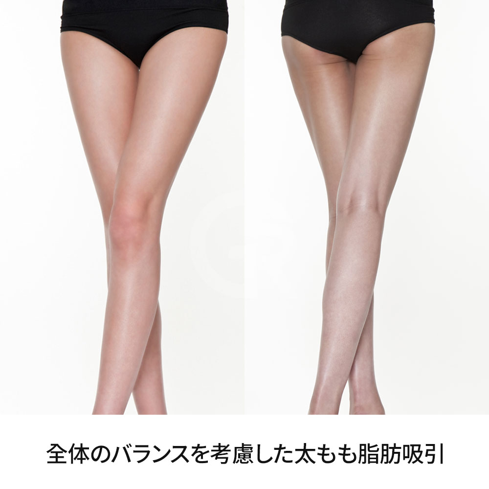 太もも脂肪吸引は単にサイズを減らす手術ではなく、自然でバランスの取れた下半身ラインを設計する手術です。