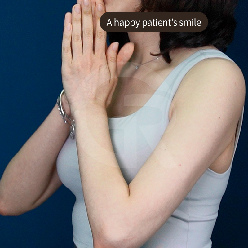 Natural-looking arm lines are achieved through careful, patient-specific design.