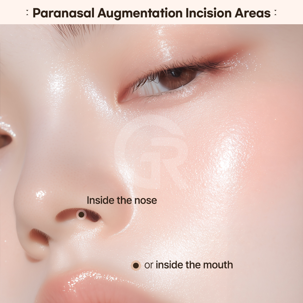 Understanding the structural cause of nasolabial folds is essential for selecting the right treatment approach.