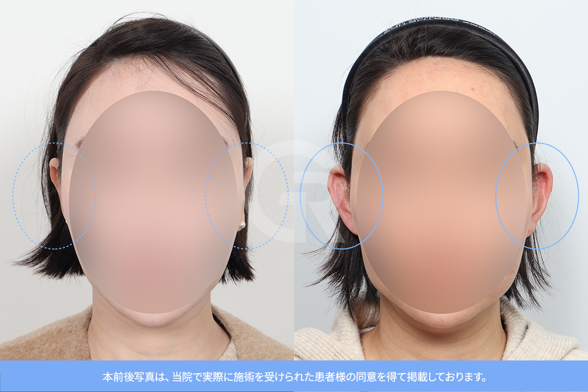 韓国で行われた寝た耳整形のビフォーアフター。正面から見たときの耳の見え方と顔のバランスが改善されています。