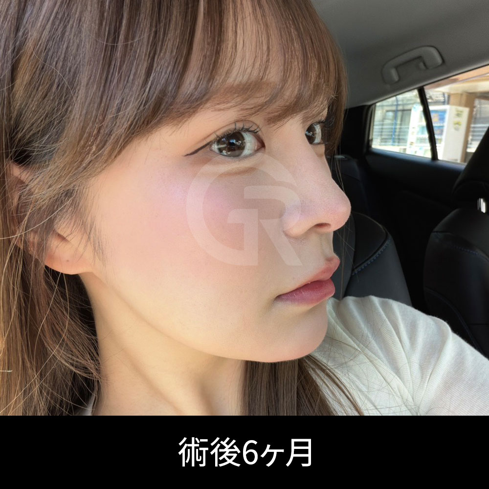 洗練された鼻整形の結果は、鼻筋、鼻先、鼻柱、小鼻の位置の調和によって決まります。