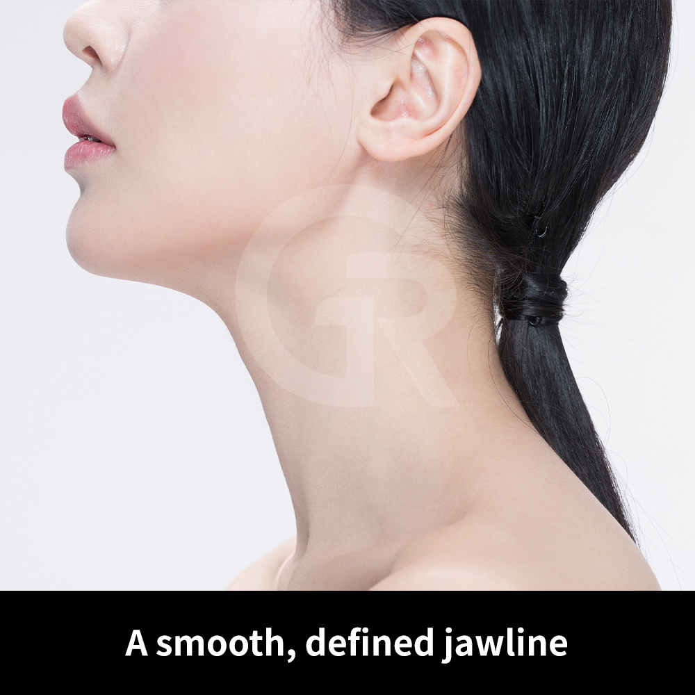 Age-related soft tissue sagging affecting the jawline