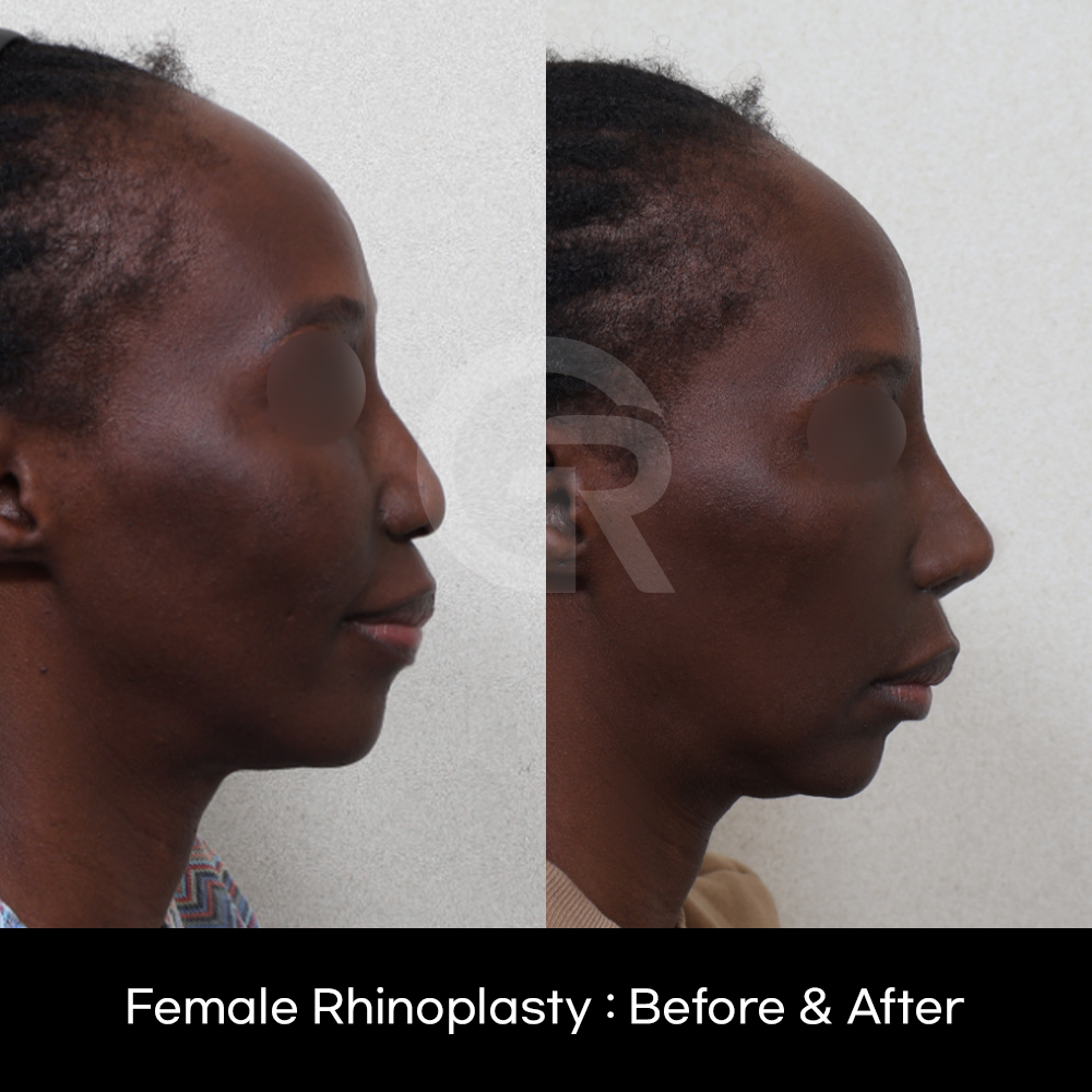 Ethnic rhinoplasty for Black patients in Korea focusing on structural support, projection, and natural facial harmony