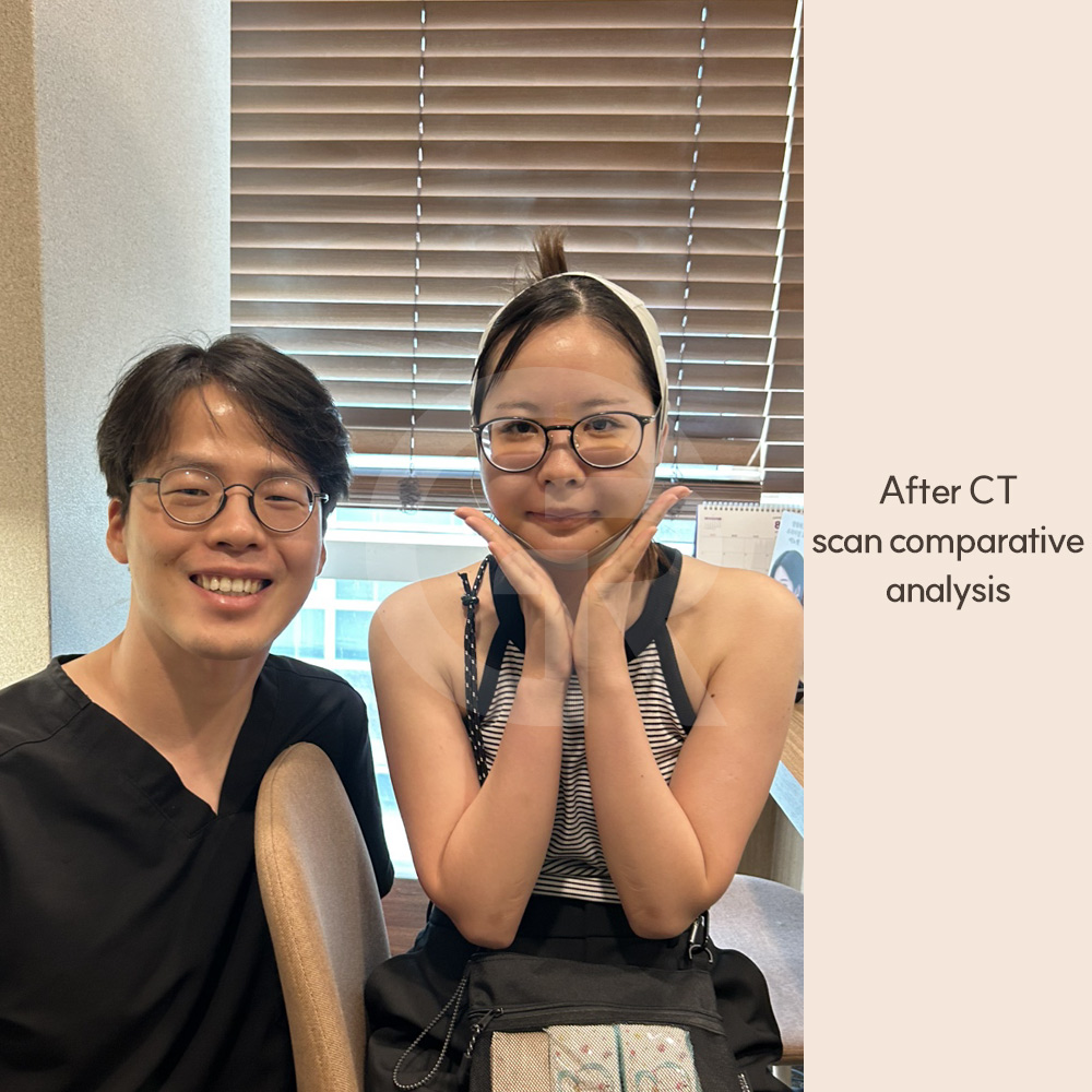Facial balance improvement after double jaw surgery, focusing on correcting midface and lower face proportions rather than simply reducing bone size.