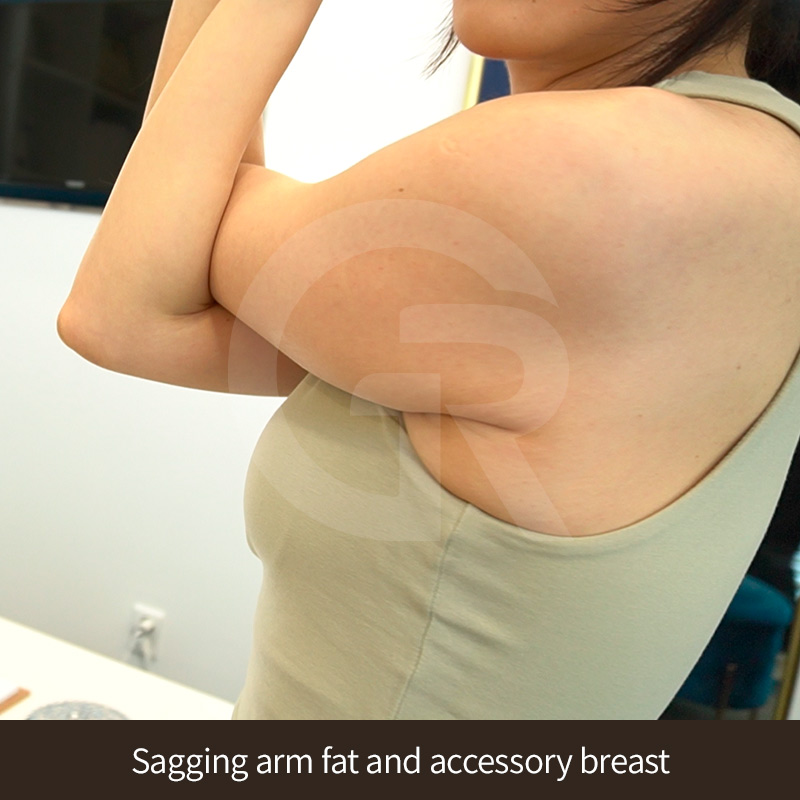 Consistent workouts may not always reduce localized fat in the upper arm area.
