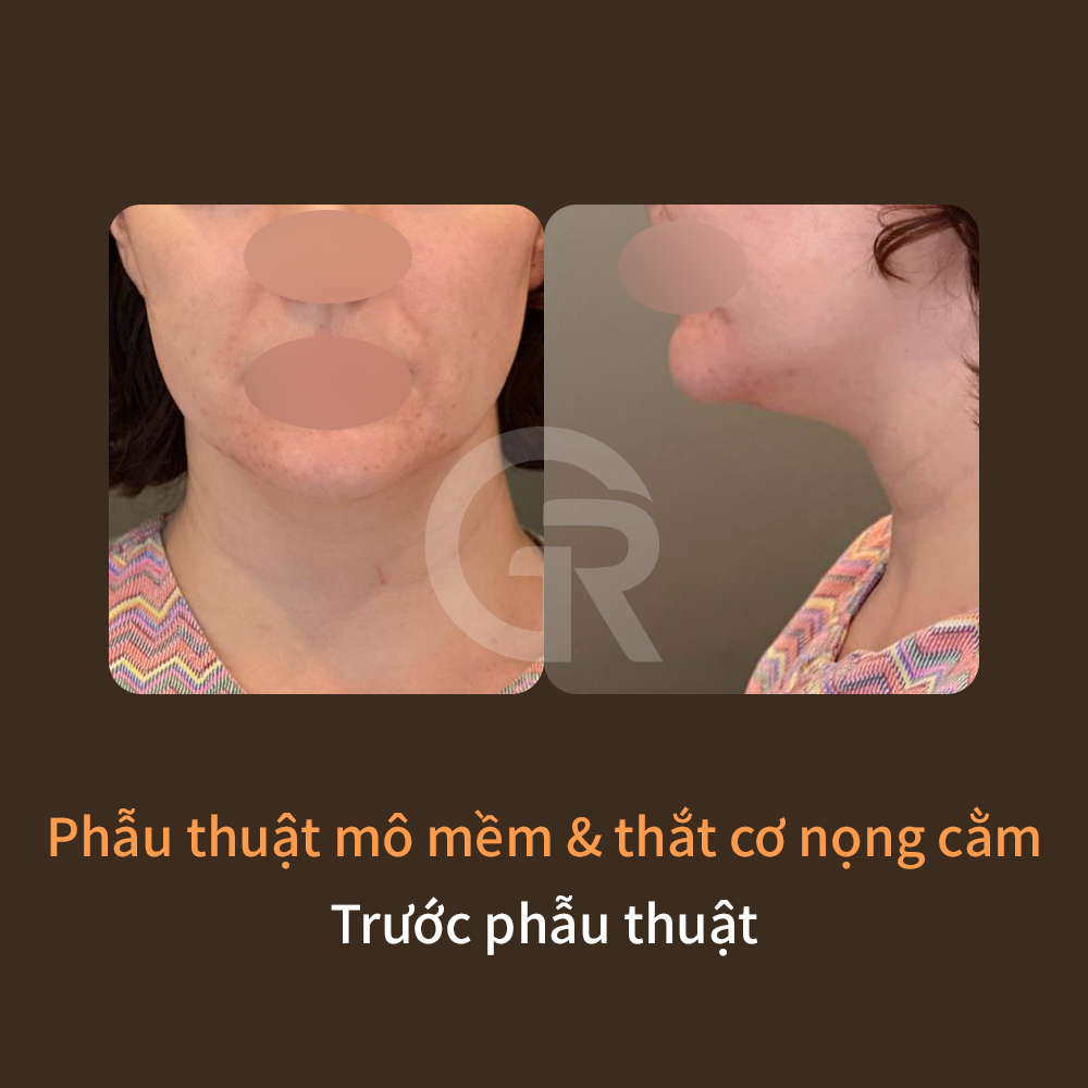 Phẫu thuật siết cơ vùng nọng cằm là hướng tiếp cận giúp sắp xếp lại nền tảng cấu trúc nâng đỡ đường viền hàm.