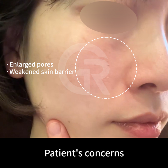Thin skin is often accompanied by increased sensitivity and a weakened skin barrier.